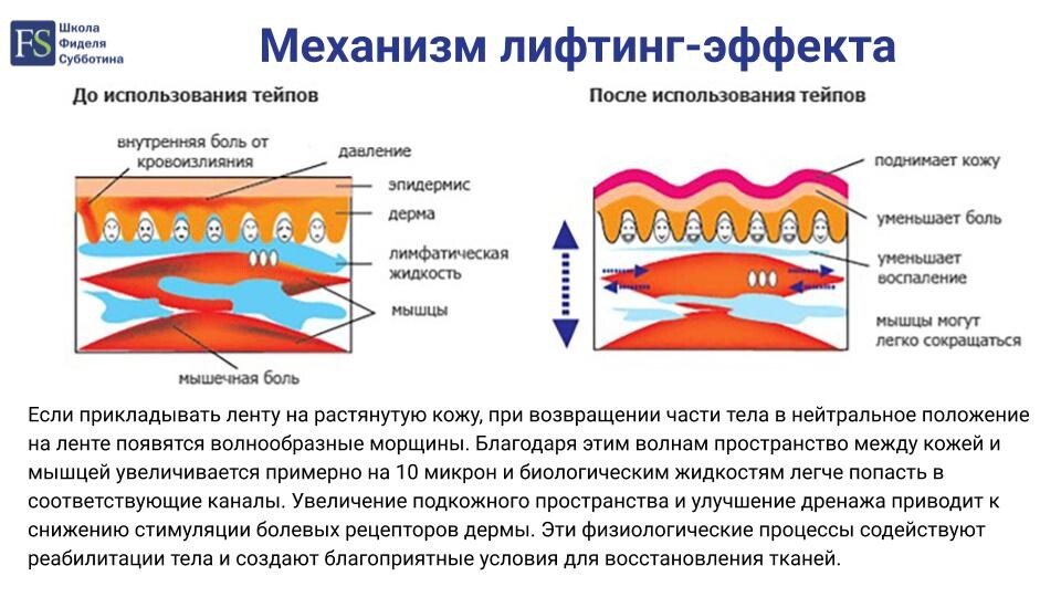 Механизм лифтинг-эффекта от тейпирования Механизм лифтинг-эффекта от тейпирования