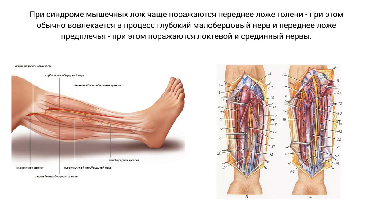 Синдром мышечных лож Синдром мышечных лож