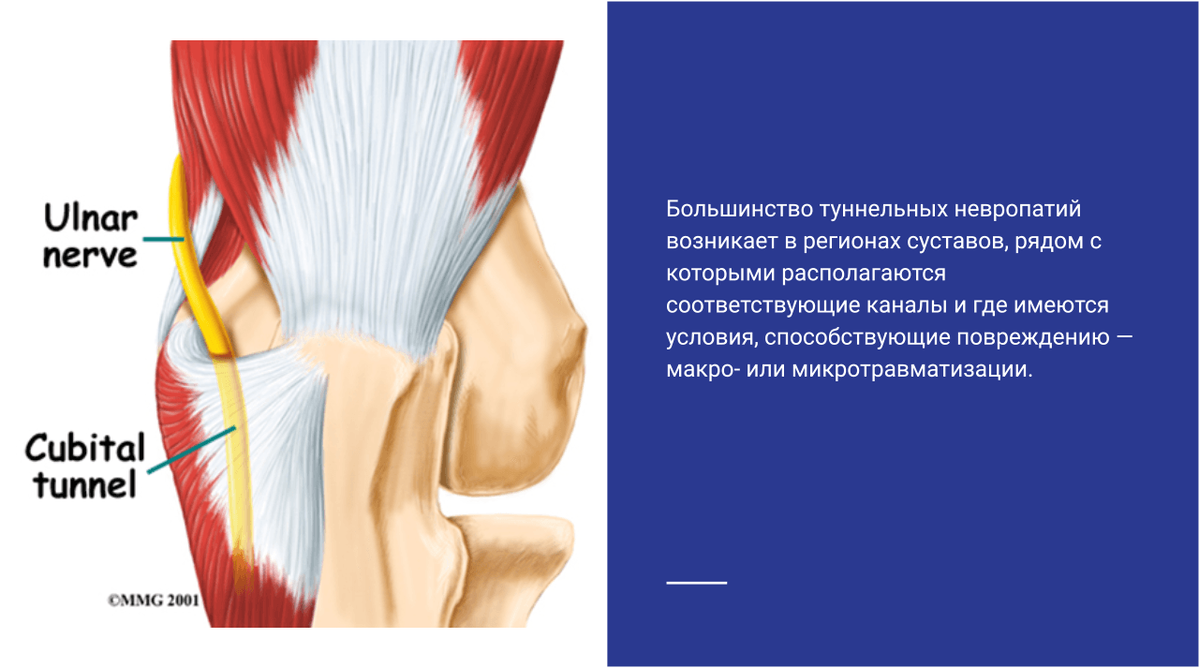 Возникновение туннельной невропатии Возникновение туннельной невропатии