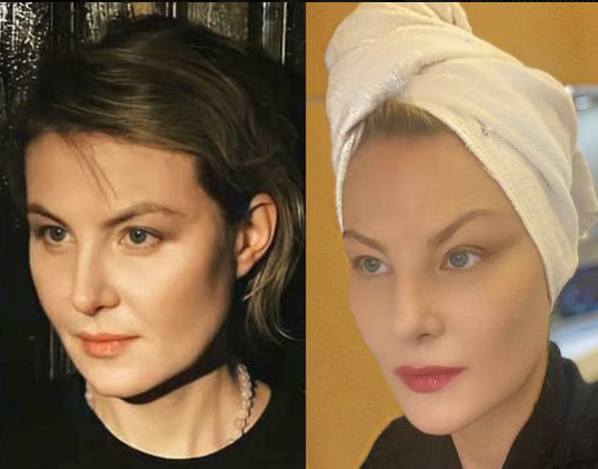 <p>По Ренате Литвиновой видно, как подтяжка сузила лицо, убрала брыли, сделала внешность аристократичной. </p>	 
		<p>По Ренате Литвиновой видно, как подтяжка сузила лицо, убрала брыли, сделала внешность аристократичной. </p>