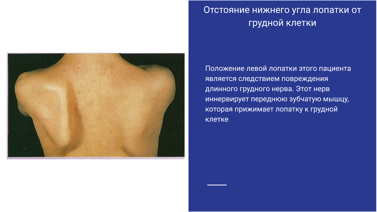 Отстояние нижнего угла лопатки от грудной клетки Отстояние нижнего угла лопатки от грудной клетки
