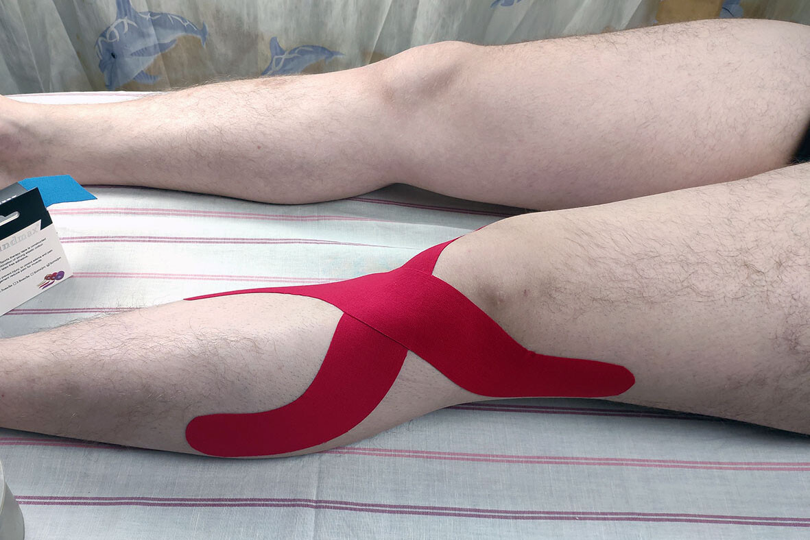 Фото 7. Тейпирование для стабилизации коленного сустава - второй отрезок тейпа