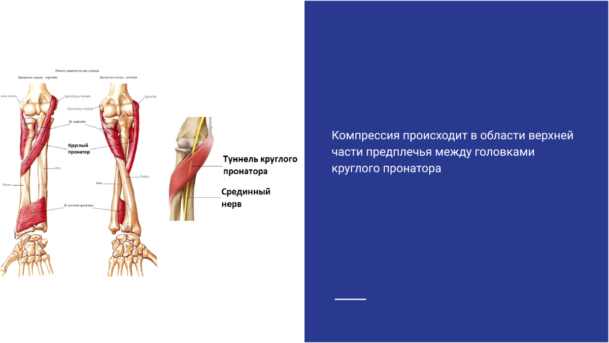 Синдром круглого пронатора