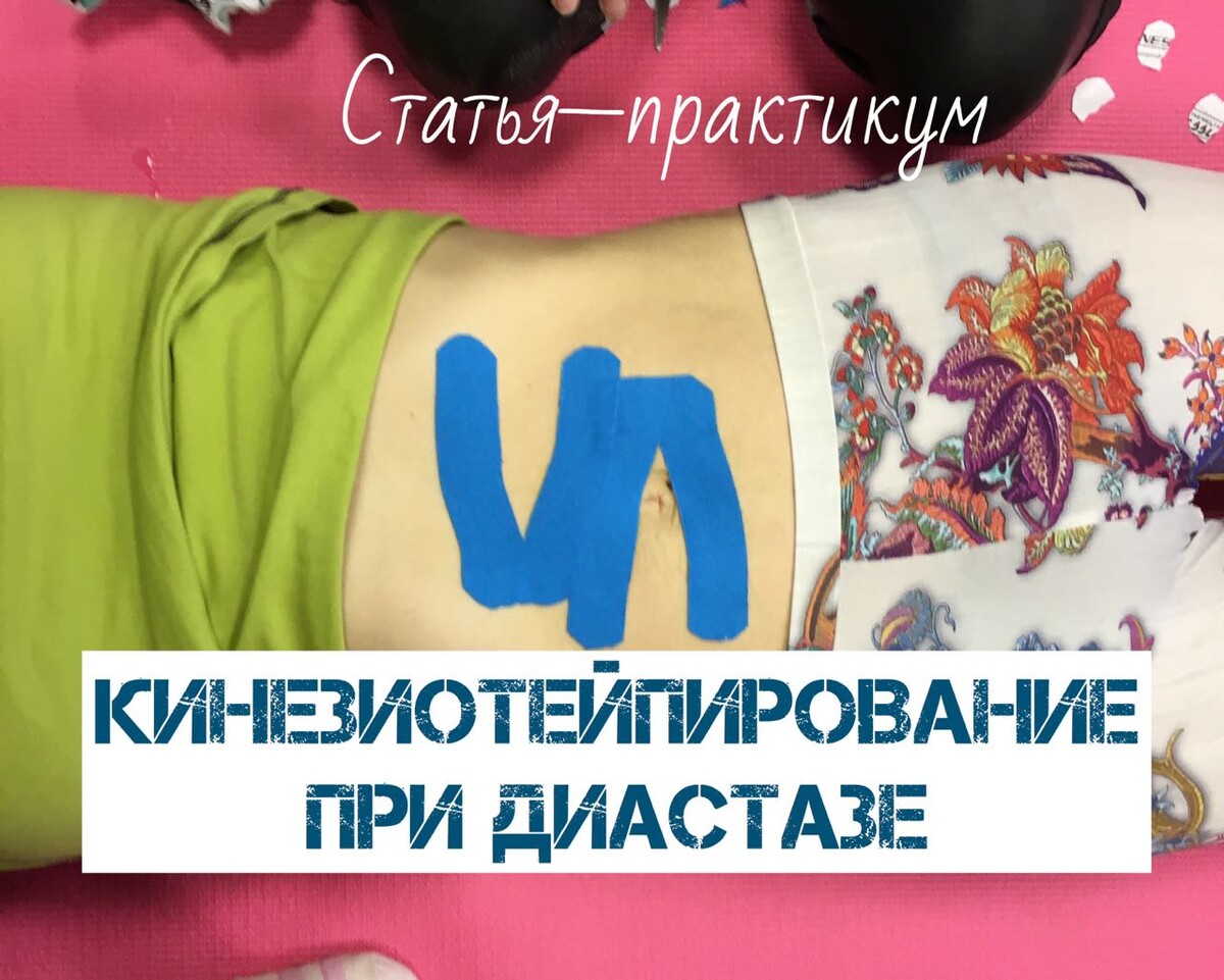 Схема тейпирования живота при диастазе
