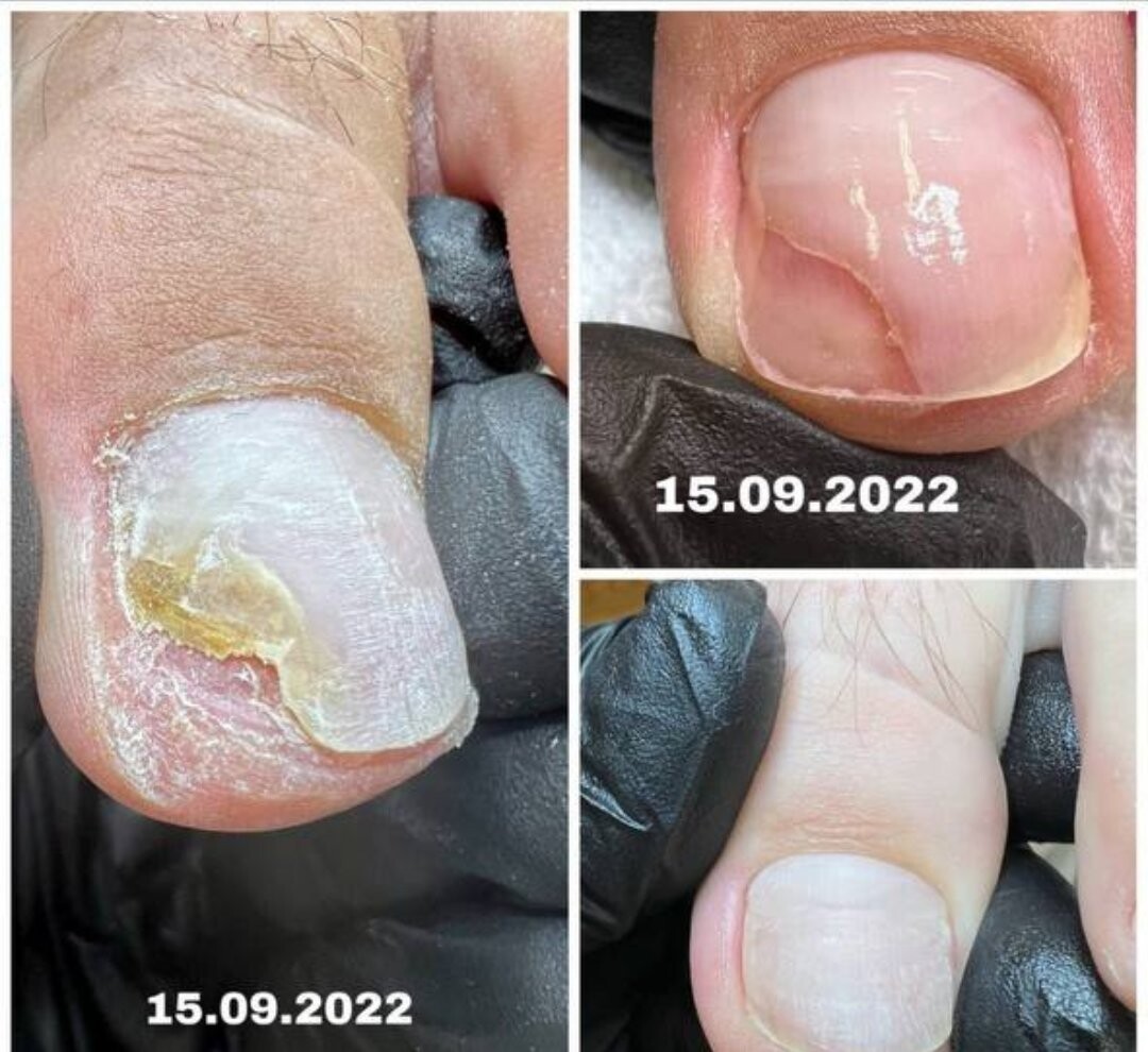 Evoluția unei unghii cu onicoliză, poze trimise de cursante