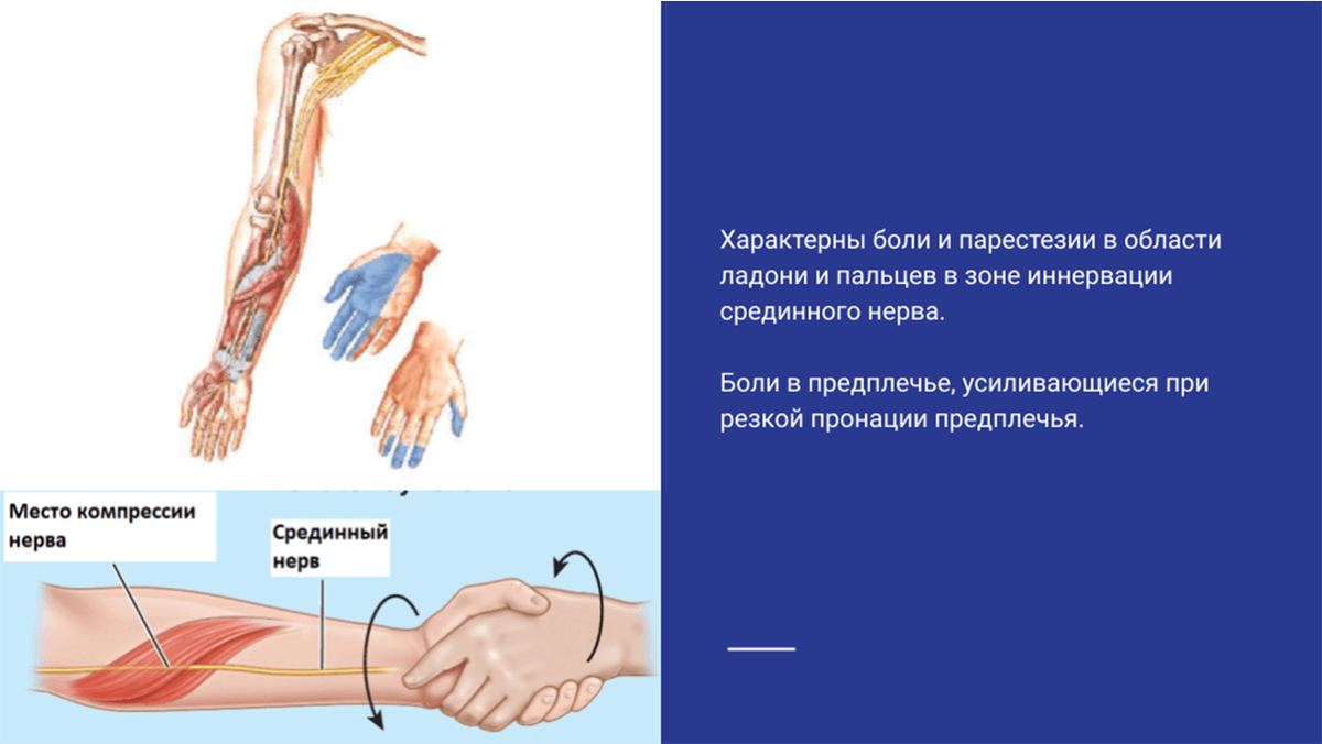 Боль при синдроме круглого пронатора предплечья