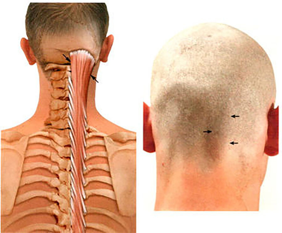 Твердый затылок. Полуостистая мышца головы. Полуостистая мышца шеи анатомия. Затылочные мышцы шеи.