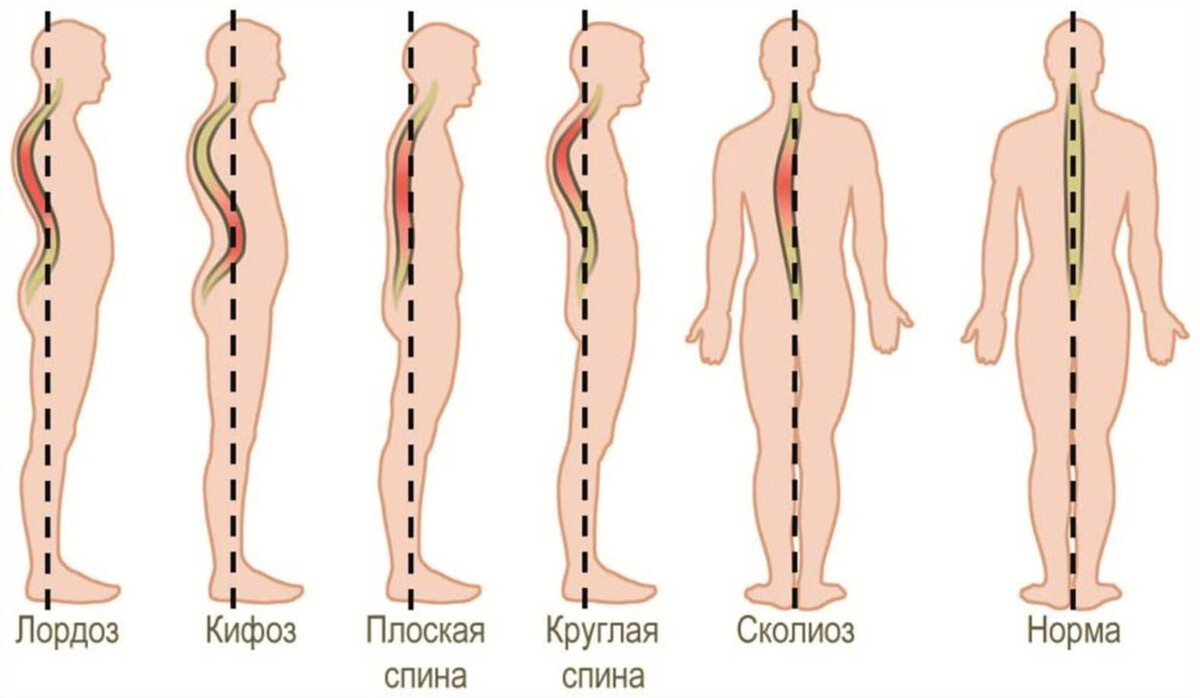 Рис. 1. Виды нарушения осанки