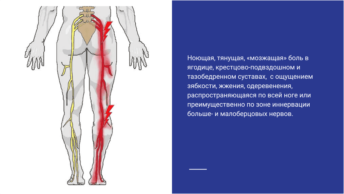Клиническая картина синдрома грушевидной мышцы