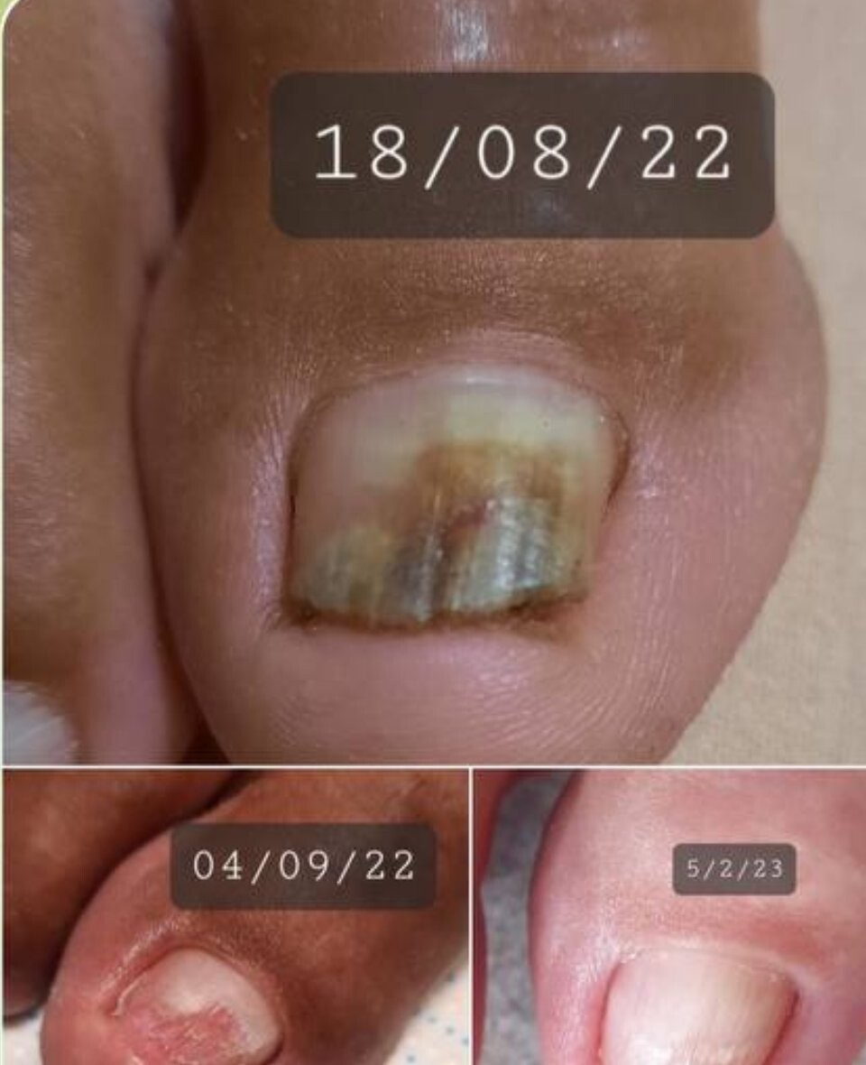 Unghie cu onicoliză în august, septembrie și februarie, trimisă de o cursantă