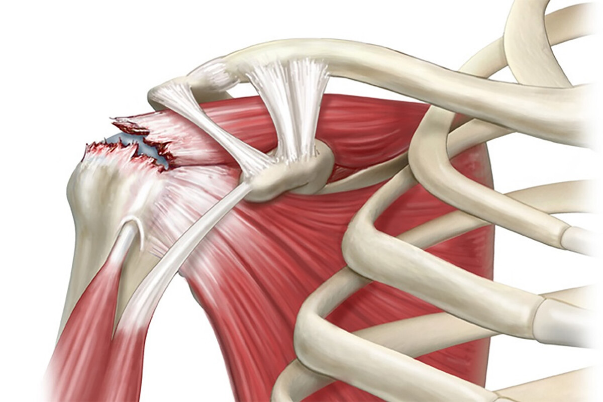 Разрыв сухожилий вращательной манжеты плеча