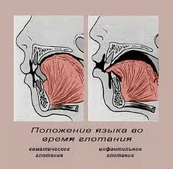 Положение языка. Инфантильный Тип глотания у детей. Неправильное глотание. Неправильное положение языка при глотании.