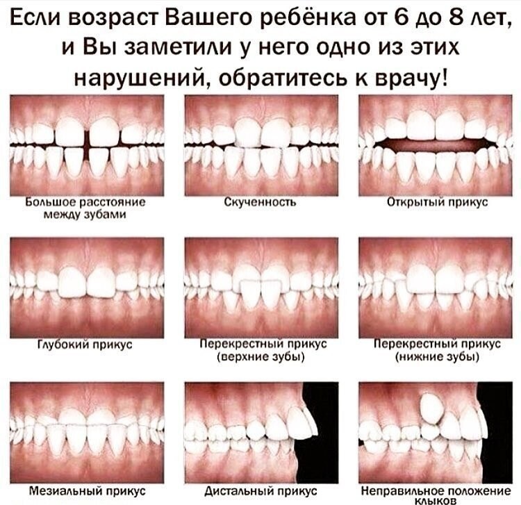 Неправильный прикус у ребенка