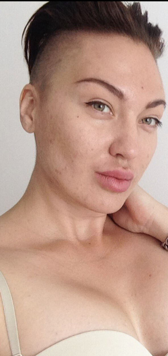 
								<p>		<em>Кожа с акне в 30</em></p>				