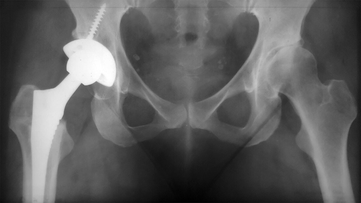 Фото 1. Рентгенография пациента с коксартрозом
