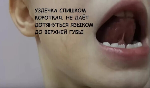 Логопед после подрезания уздечки у ребенка. Блог Лого Портал