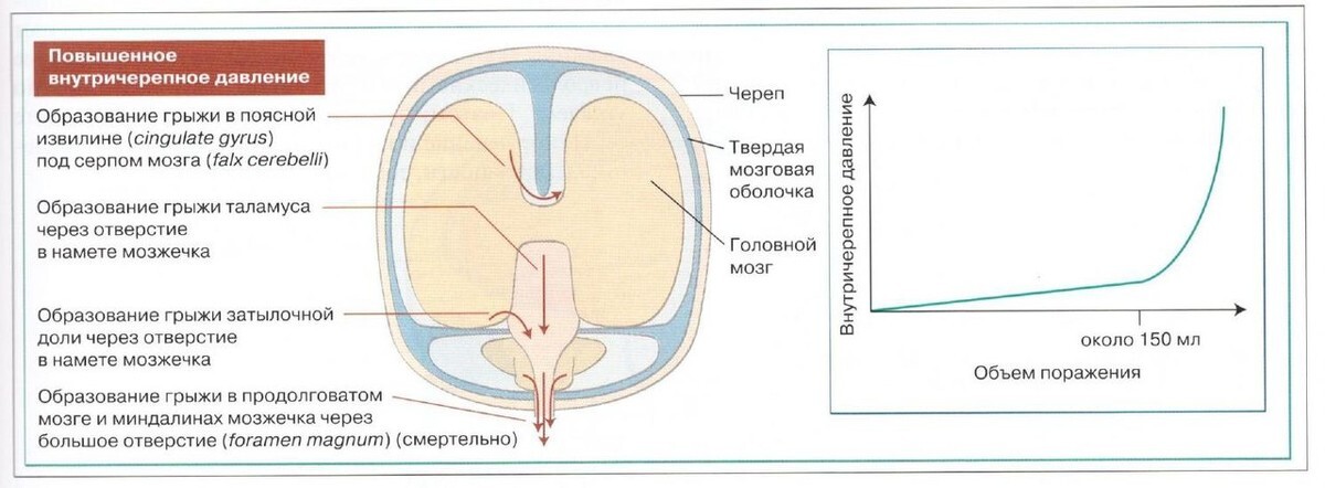 Внутричерепное давление симптомы у взрослых. Схема повышения внутричерепного давления. Внутричерепное давление при коронавирусе. Как понять что у тебя внутричерепное давление. Современные подходы к оценке внутричерепного давления.