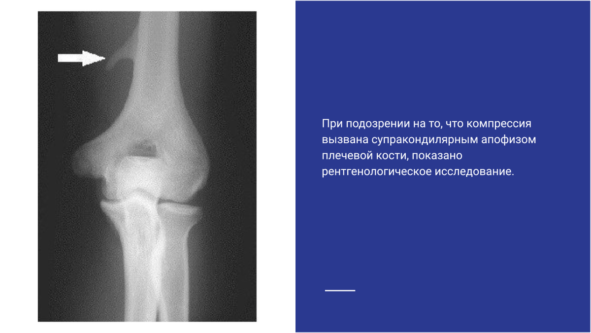 Рентгенологическое исследование при компрессии супракондилярного отростка плеча