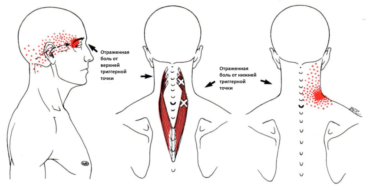 Расположение триггерных точек ременной мышцы шеи