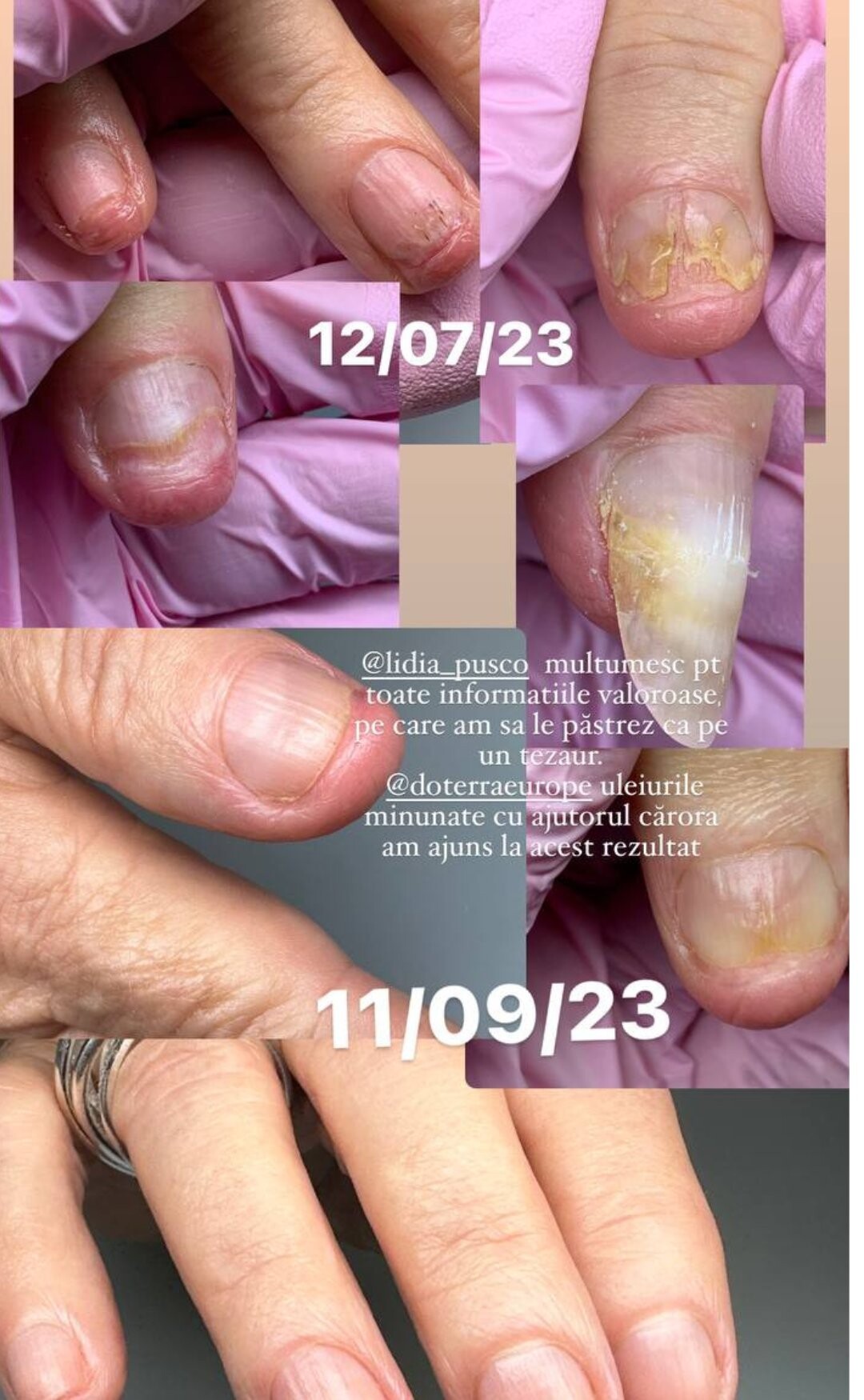 Unghii de la mâini cu onicoliză, în iulie și în septembrie