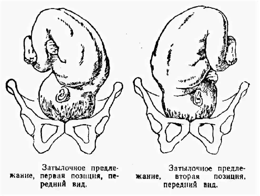 Передний вид. Затылочное предлежание плода передний вид. Головное предлежание плода 1 позиция передний вид. Головное предлежание плода 2 позиция. Задний вид затылочного предлежания биомеханизм родов.