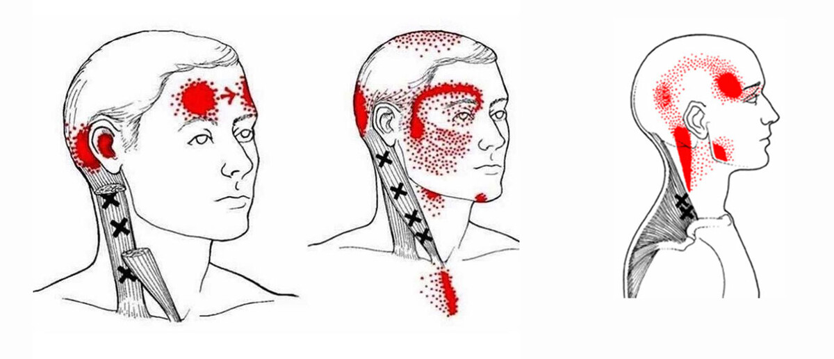 Триггерные точки в ГКС и трапециевидной мышце, вызывающий сателлитные точки в височной мышце