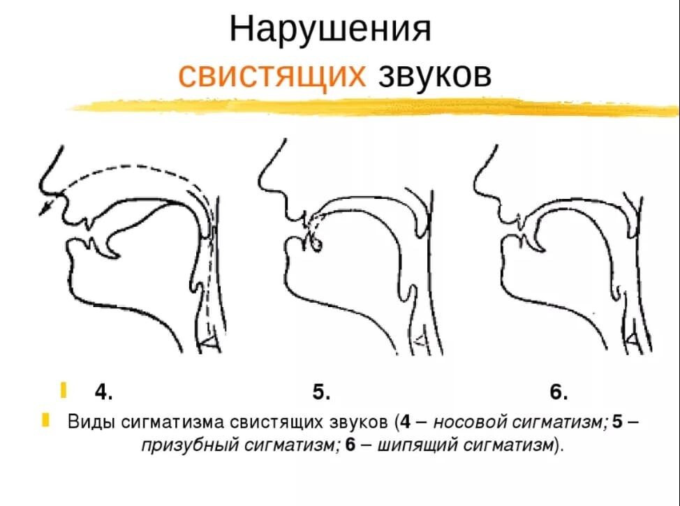 План логопедической работы по преодолению нарушения звукопроизношения межзубный сигматизм