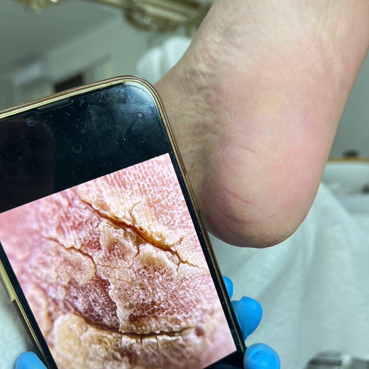 Crăpături dermale fotografiate de aproape, pe telefon, în timpul diagnosticării