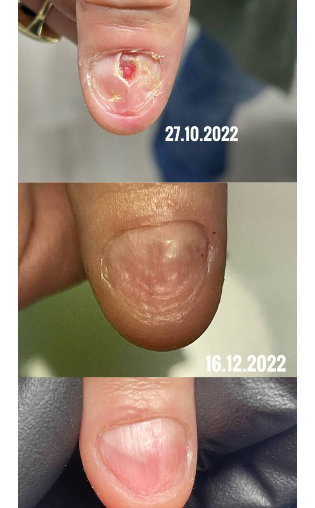 Evoluția unei unghii cu onicoliză, poze trimise de cursante