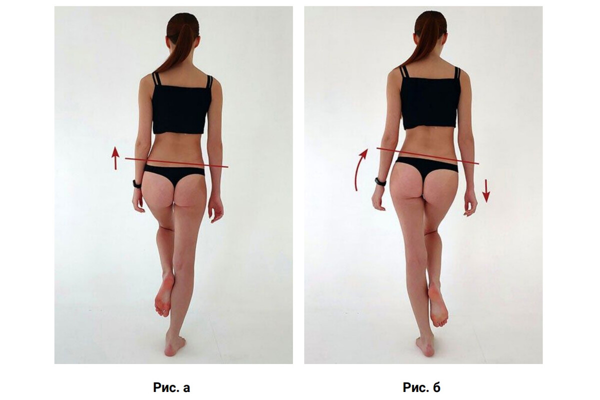 Феномен Тренделенбурга (Trendelenburg)