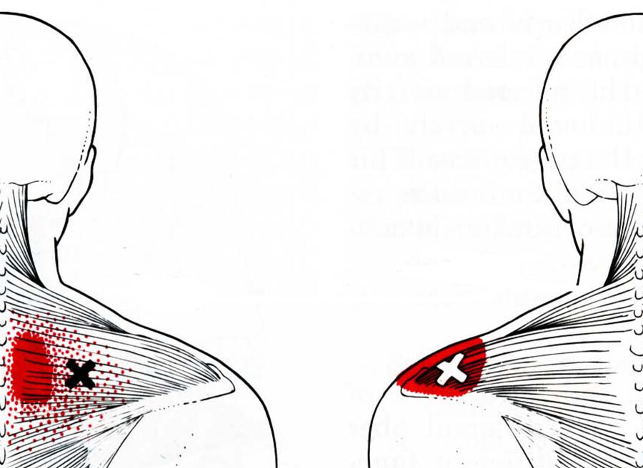 Боль при поражении средней порции трапециевидной мышцы