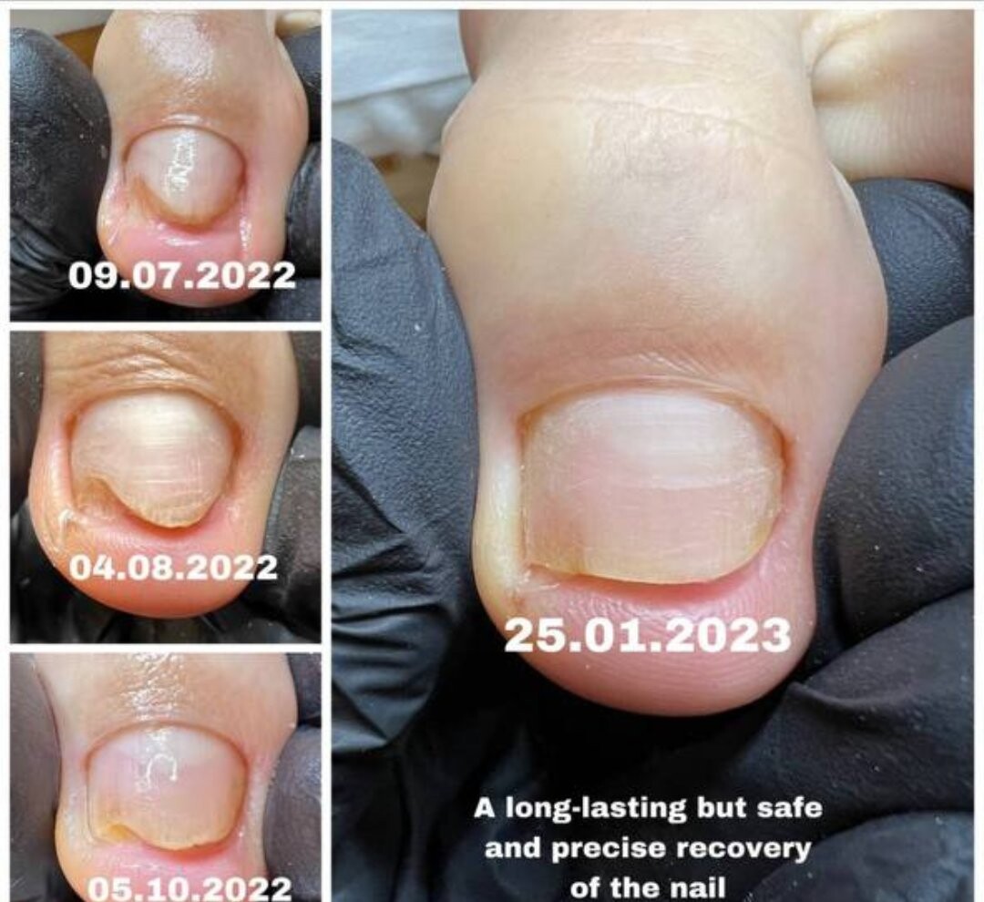 Evoluția unei unghii cu onicoliză, poze trimise de cursante