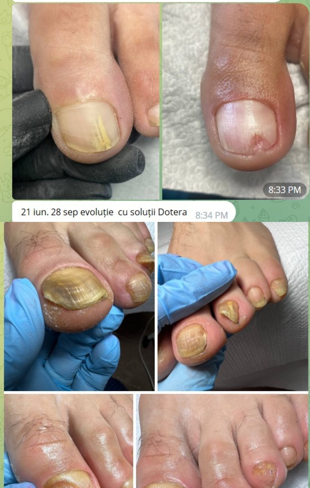 Evoluția unei unghii cu onicoliză, poze trimise de cursante