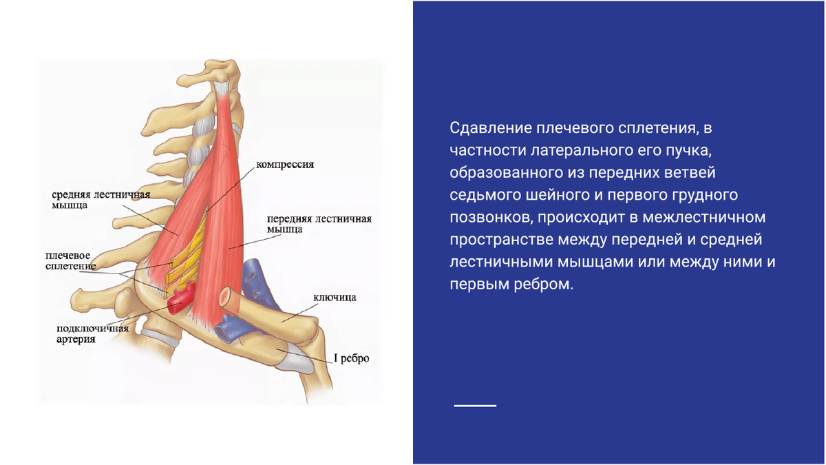 Синдромы грудного выхода (TOS)