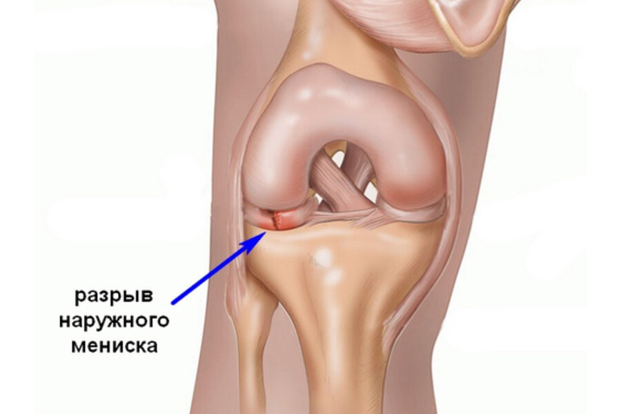 Разрыв наружного мениска